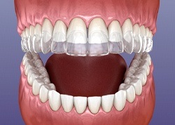 Invisalign illustration