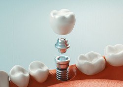 dental implant illustration