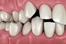 Crowded teeth can be spaced more evenly with SureSmile treatment