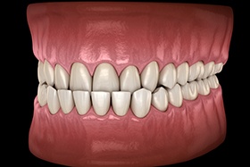 SureSmile can be used to address an underbite