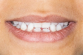 Crossbite is an oral health condition that can be corrected with SureSmile