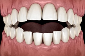 SureSmile can correct an open bite
