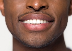 An up-close image of a man’s mouth with his veneers exposed