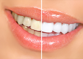 A woman having her teeth whitened at a dental clinic