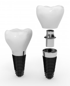 dental implants