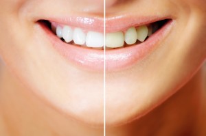 teeth whitening results2