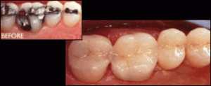 tooth-colored fillings