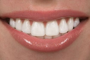 Porcelain Veneers Palm Beach FL