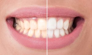 Change your dull, yellow smile into a bright one with teeth whitening in Juno Beach. Easy and safe, this aesthetic procedure improves lives.