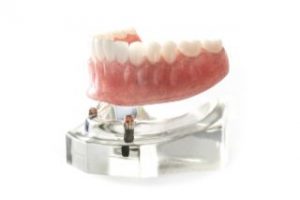 Implant-retained lower denture