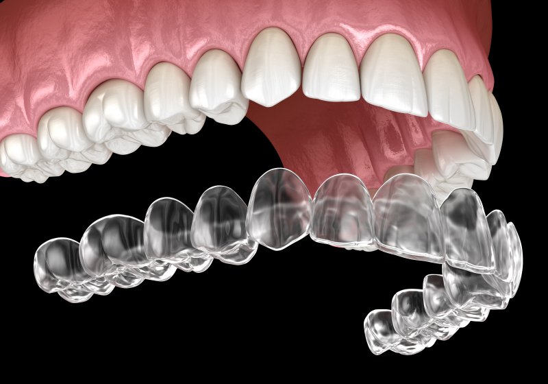 Digital image of an Invisalign aligner being placed on a top row of teeth