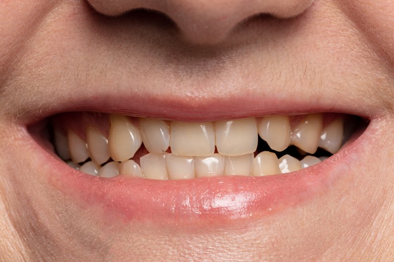 close up of person smiling with yellow teeth