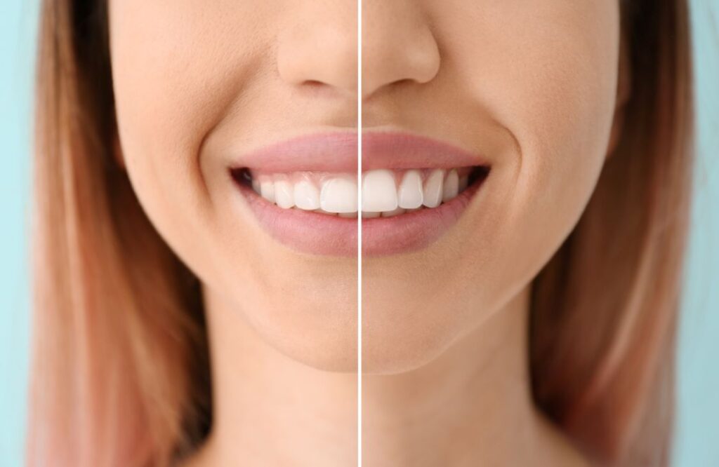 A woman’s smile before and after laser gum contouring