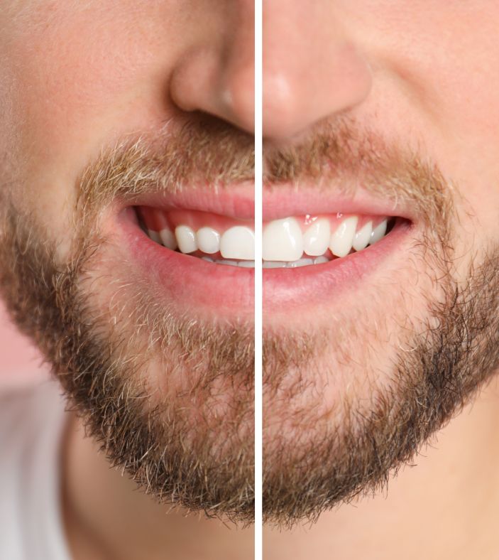 A man before and after laser gum contouring